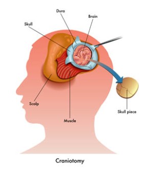 Partial Craniotomy by OrangeCountySurgeons.org  (2)